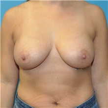 Breast Augmentation After Photo by Joshua Cooper, MD; Seattle, WA - Case 46529