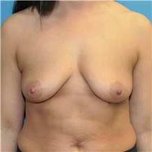 Breast Augmentation Before Photo by Joshua Cooper, MD; Seattle, WA - Case 46529