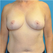 Breast Reduction After Photo by Joshua Cooper, MD; Seattle, WA - Case 46570