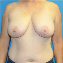 Breast Reduction Before Photo by Joshua Cooper, MD; Seattle, WA - Case 46570