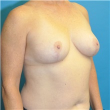 Breast Reduction After Photo by Joshua Cooper, MD; Seattle, WA - Case 46570