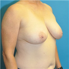 Breast Reduction Before Photo by Joshua Cooper, MD; Seattle, WA - Case 46570