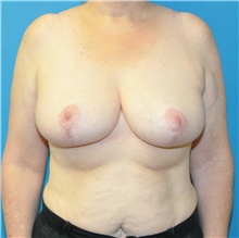 Breast Reduction After Photo by Joshua Cooper, MD; Seattle, WA - Case 46573