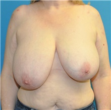 Breast Reduction Before Photo by Joshua Cooper, MD; Seattle, WA - Case 46573