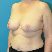 Breast Reduction After Photo by Joshua Cooper, MD; Seattle, WA - Case 46573