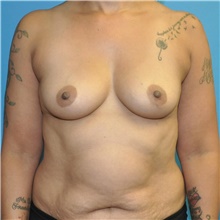 Breast Augmentation Before Photo by Joshua Cooper, MD; Seattle, WA - Case 46938