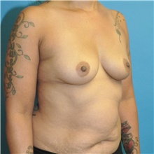 Breast Augmentation Before Photo by Joshua Cooper, MD; Seattle, WA - Case 46938