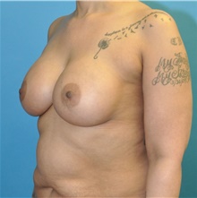 Breast Augmentation After Photo by Joshua Cooper, MD; Seattle, WA - Case 46938