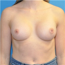 Breast Augmentation After Photo by Joshua Cooper, MD; Seattle, WA - Case 46943