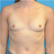 Breast Augmentation Before Photo by Joshua Cooper, MD; Seattle, WA - Case 46943