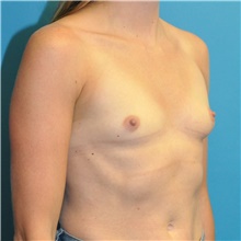 Breast Augmentation Before Photo by Joshua Cooper, MD; Seattle, WA - Case 46943