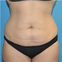 Tummy Tuck Before Photo by Joshua Cooper, MD; Seattle, WA - Case 47210