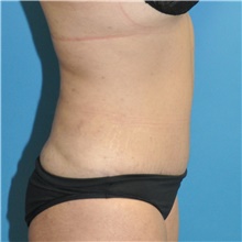 Tummy Tuck After Photo by Joshua Cooper, MD; Seattle, WA - Case 47210