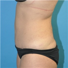 Tummy Tuck After Photo by Joshua Cooper, MD; Seattle, WA - Case 47210