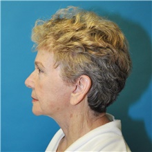 Facelift After Photo by Joshua Cooper, MD; Seattle, WA - Case 47225