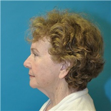 Facelift Before Photo by Joshua Cooper, MD; Seattle, WA - Case 47225