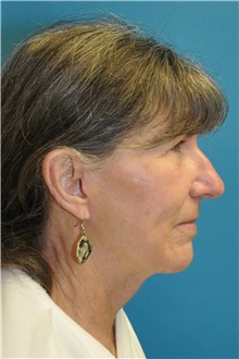 Facelift After Photo by Joshua Cooper, MD; Seattle, WA - Case 47226
