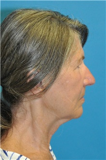 Facelift Before Photo by Joshua Cooper, MD; Seattle, WA - Case 47226