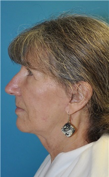 Facelift After Photo by Joshua Cooper, MD; Seattle, WA - Case 47226
