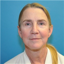 Facelift After Photo by Joshua Cooper, MD; Seattle, WA - Case 47503