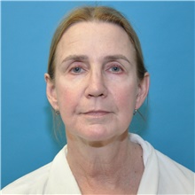 Facelift Before Photo by Joshua Cooper, MD; Seattle, WA - Case 47503