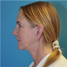 Facelift After Photo by Joshua Cooper, MD; Seattle, WA - Case 47503