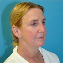 Facelift Before Photo by Joshua Cooper, MD; Seattle, WA - Case 47503