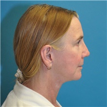 Facelift After Photo by Joshua Cooper, MD; Seattle, WA - Case 47503