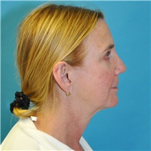 Facelift Before Photo by Joshua Cooper, MD; Seattle, WA - Case 47503