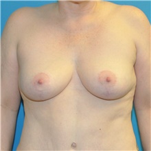 Breast Lift After Photo by Joshua Cooper, MD; Seattle, WA - Case 47655