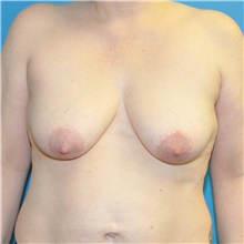 Breast Lift Before Photo by Joshua Cooper, MD; Seattle, WA - Case 47655