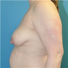 Breast Lift Before Photo by Joshua Cooper, MD; Seattle, WA - Case 47655