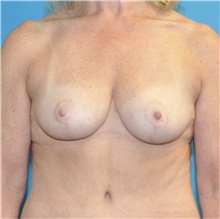Breast Lift After Photo by Joshua Cooper, MD; Seattle, WA - Case 47657