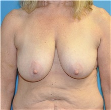 Breast Lift Before Photo by Joshua Cooper, MD; Seattle, WA - Case 47657