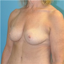 Breast Lift After Photo by Joshua Cooper, MD; Seattle, WA - Case 47657
