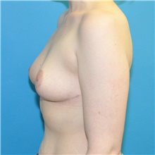 Breast Reduction After Photo by Joshua Cooper, MD; Seattle, WA - Case 47871
