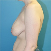 Breast Reduction Before Photo by Joshua Cooper, MD; Seattle, WA - Case 47871