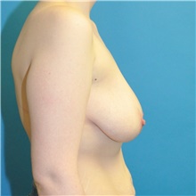 Breast Reduction Before Photo by Joshua Cooper, MD; Seattle, WA - Case 47871