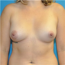 Breast Augmentation After Photo by Joshua Cooper, MD; Seattle, WA - Case 47931