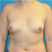 Breast Augmentation Before Photo by Joshua Cooper, MD; Seattle, WA - Case 47931