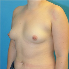 Breast Augmentation Before Photo by Joshua Cooper, MD; Seattle, WA - Case 47931