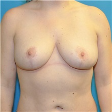 Breast Reduction After Photo by Joshua Cooper, MD; Seattle, WA - Case 48219