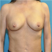 Breast Augmentation After Photo by Joshua Cooper, MD; Seattle, WA - Case 48220