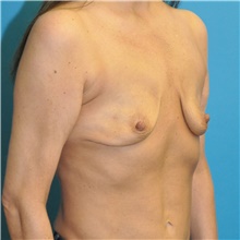 Breast Augmentation Before Photo by Joshua Cooper, MD; Seattle, WA - Case 48220