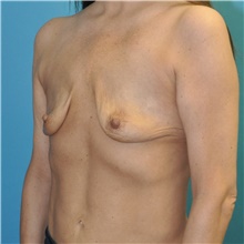 Breast Augmentation Before Photo by Joshua Cooper, MD; Seattle, WA - Case 48220