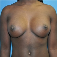 Breast Augmentation After Photo by Joshua Cooper, MD; Seattle, WA - Case 48221