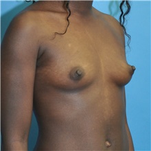 Breast Augmentation Before Photo by Joshua Cooper, MD; Seattle, WA - Case 48221