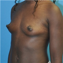 Breast Augmentation Before Photo by Joshua Cooper, MD; Seattle, WA - Case 48221