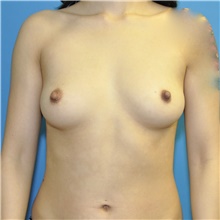 Breast Augmentation Before Photo by Joshua Cooper, MD; Seattle, WA - Case 48223