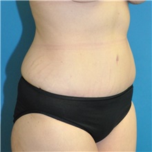 Tummy Tuck After Photo by Joshua Cooper, MD; Seattle, WA - Case 48375
